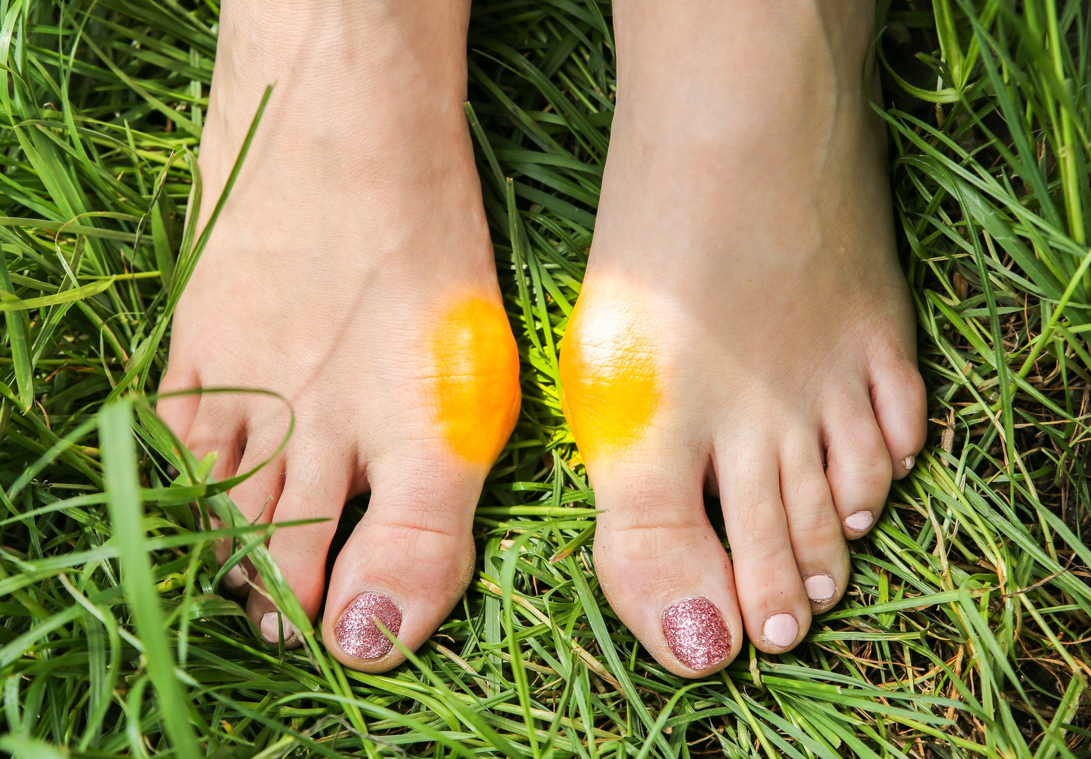 What Really Causes Bunions: Shoes or Genetics?