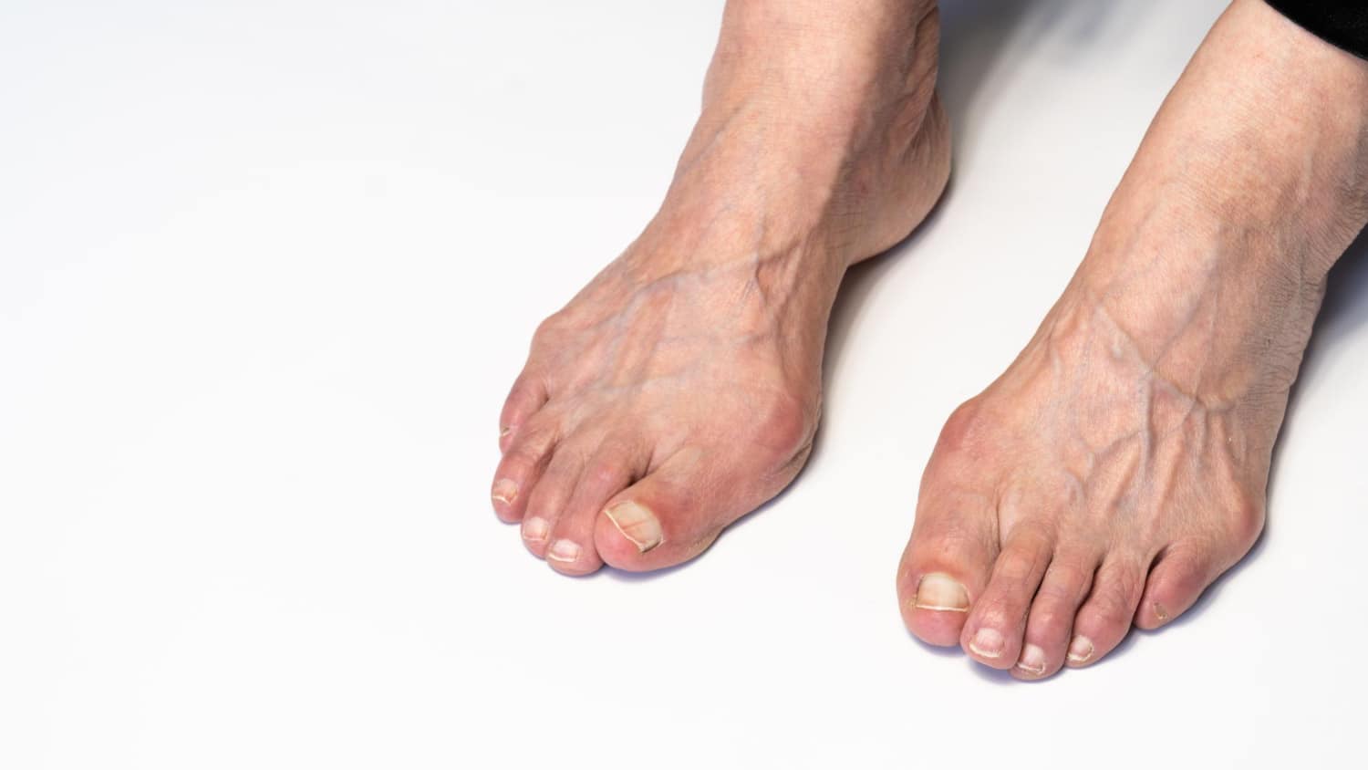 Can you have a bunion deformity and still have a straight toe